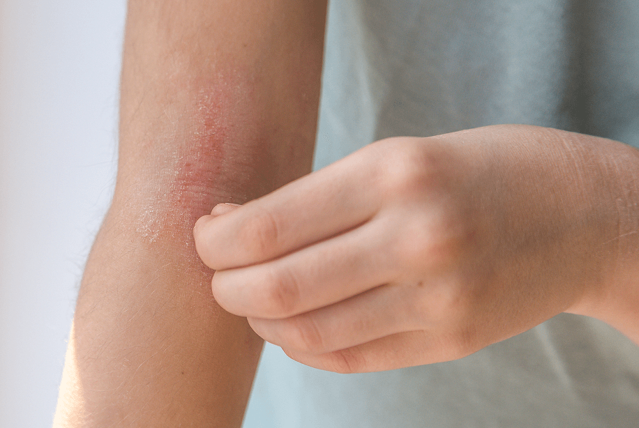 Girl scratching eczema spot on her arm.