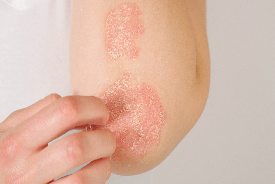 Girl scratching a patch of psoriasis on her elbow.